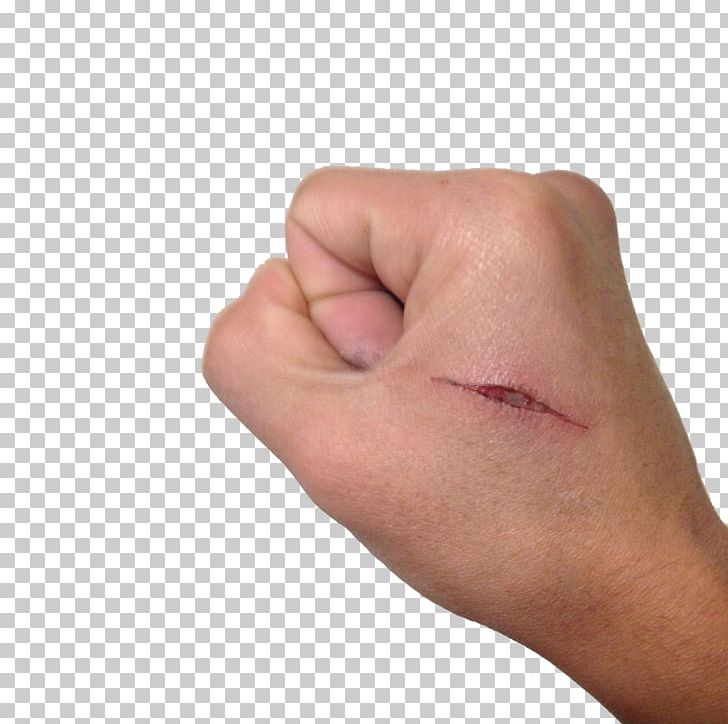 Hand Thumb Scar PNG, Clipart, Arm, Check Mark, Cheek, Chin, Exclamation Mark Free PNG Download
