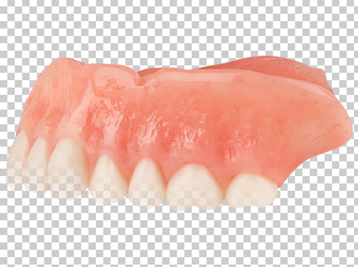 Dentures Tooth Dentistry Dental Implant PNG, Clipart, Aspen, Aspen Dental, Brewer Dental Center, Bridge, Child Free PNG Download