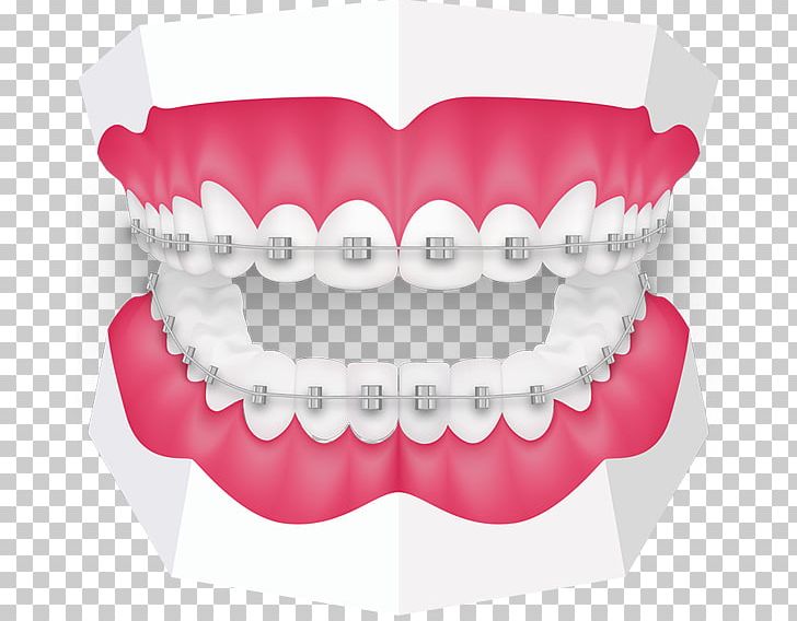 Tooth Orthodontics Dentistry Dental Braces Oral Hygiene PNG, Clipart, Cadcam Dentistry, Clinic, Dental Braces, Dentistry, Health Free PNG Download