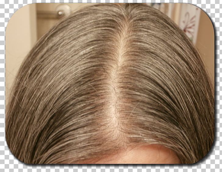 Hair Loss Blond Hair Coloring Human Hair Growth PNG, Clipart, Blond, Brown Hair, Eye Shadow, Forehead, Hair Free PNG Download