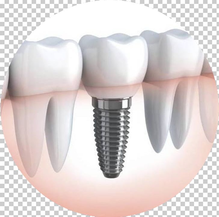 Dental Implant Dentistry Dentures PNG, Clipart, Cosmetic Dentistry, Crown, Dental Extraction, Dental Implant, Dentist Free PNG Download