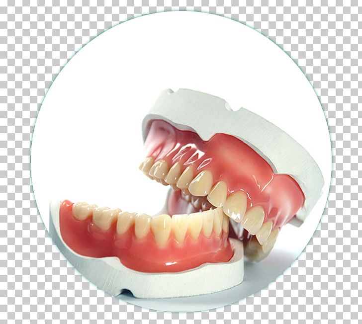 Dentures Prosthesis Dentistry Tooth PNG, Clipart, Cosmetic Dentistry, Crown, Dental Implant, Dental Prosthesis, Dentist Free PNG Download