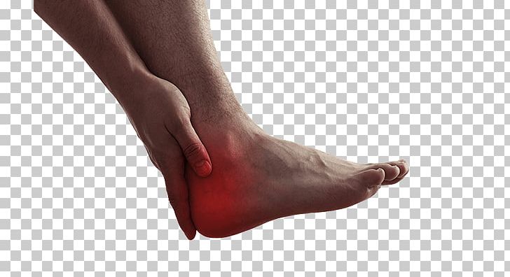 Heel Pain Calcaneal Spur Ankle Plantar Fasciitis PNG, Clipart, Ache, Achilles Tendinitis, Ankle, Calcaneal Spur, Calcaneus Free PNG Download