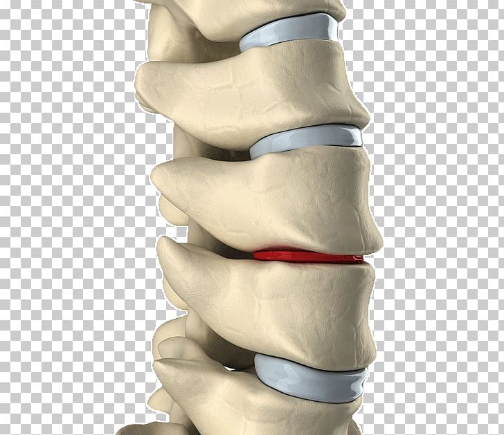 Lumbar Disc Herniation Intervertebral Disc Spinal Decompression Back Pain Vertebral Column PNG, Clipart, Arm, Back Pain, Finger, Hand, Health Free PNG Download