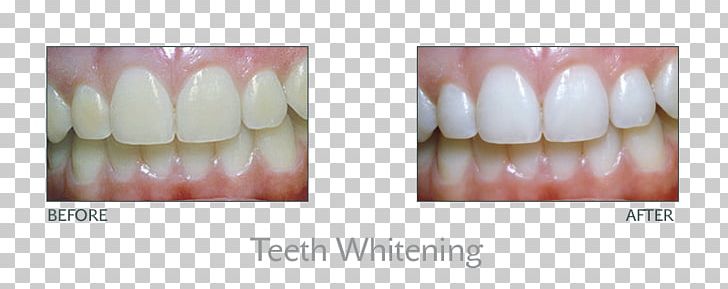 Tooth Whitening Dentistry Human Tooth PNG, Clipart, Beauty, Chin, Cosmetic Dentistry, Dentist, Dentistry Free PNG Download