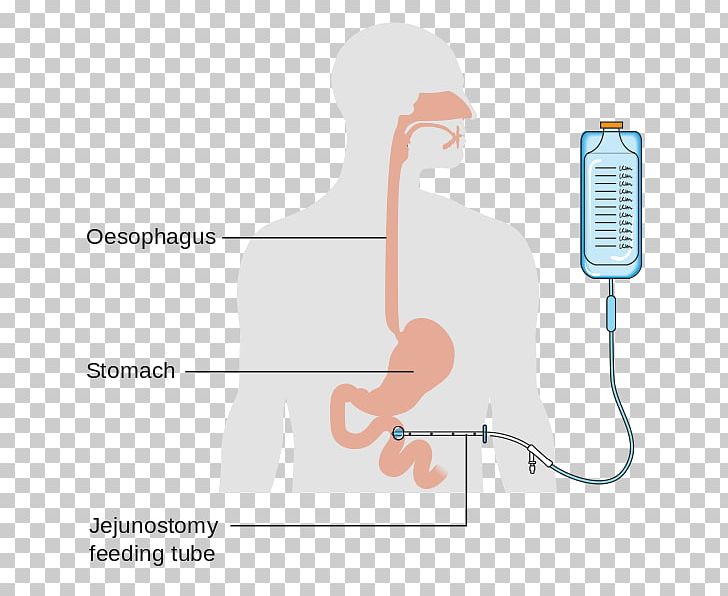 Jejunostomy Feeding Tube Percutaneous Endoscopic Gastrostomy Nasogastric Intubation PNG, Clipart, Audio Equipment, Communication, Diagram, Ear, Feeding Tube Free PNG Download