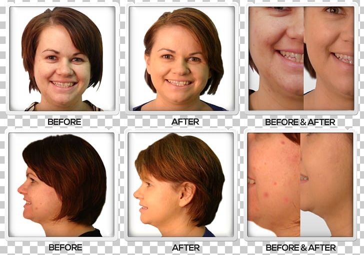 Cheek Nose Acne Lost 118 Chin PNG, Clipart, Acne, After, Annie, Before, Before After Free PNG Download
