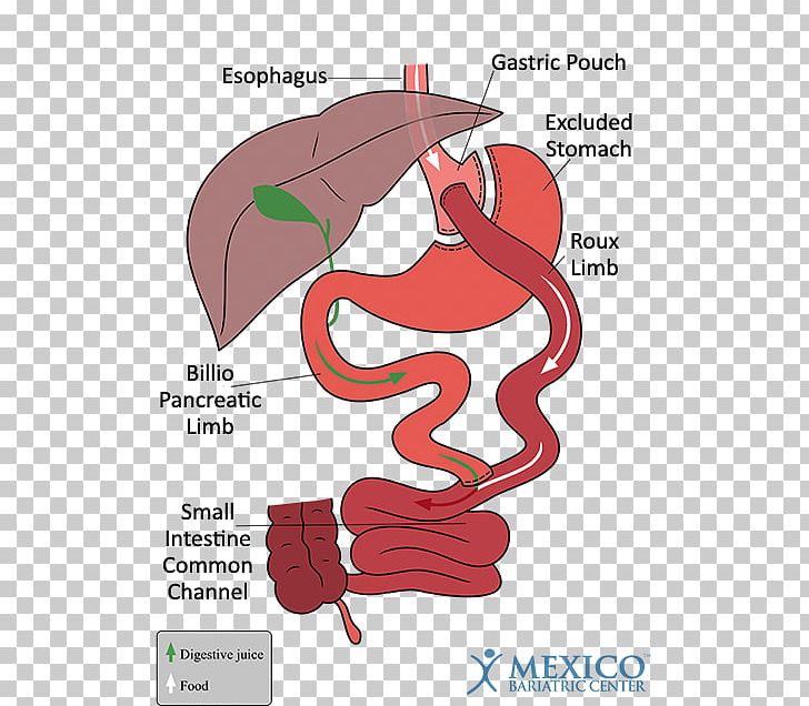 Gastric Bypass Surgery Bariatric Surgery Sleeve Gastrectomy Gastric Balloon PNG, Clipart, Arm, Art, Bariatrics, Bariatric Surgery, Bypass Surgery Free PNG Download