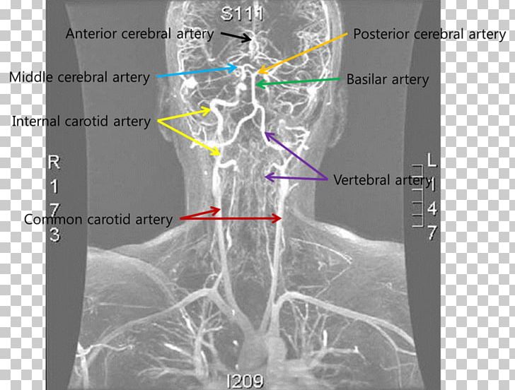 Medical Imaging Vertebral Artery Dissection Blood Vessel PNG, Clipart, Agy, Anatomy, Artery, Blood Vessel, Common Carotid Artery Free PNG Download