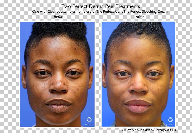 Chemical Peel Dermis Skin The Perfect Derma Peel Face PNG, Clipart, Cheek, Chemical Peel, Child, Chin, Complexion Free PNG Download