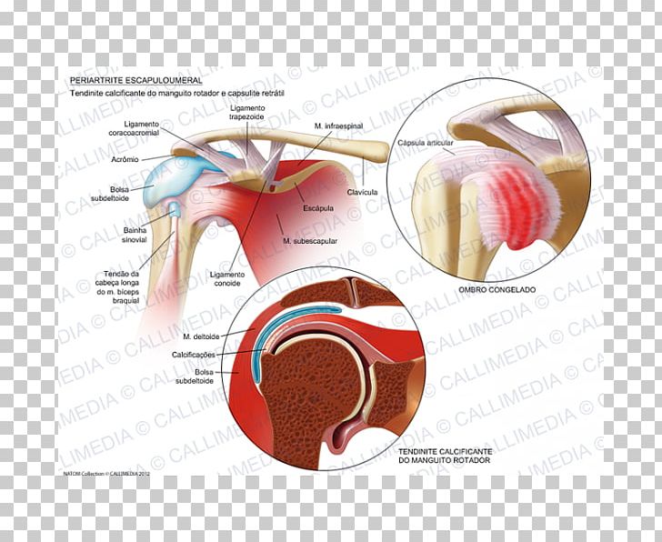 Adhesive Capsulitis Of Shoulder Arthritis Periartrite Scapolo-omerale Rheumatology Ache PNG, Clipart, Ache, Adhesive Capsulitis Of Shoulder, Arthritis, Calcific Tendinitis, Diagram Free PNG Download