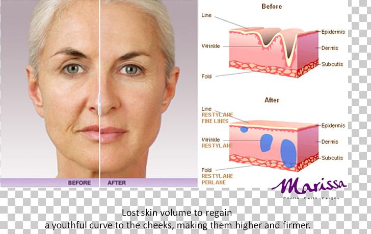Injectable Filler Juvéderm Timeless Aesthetics MedSpa Hyaluronic Acid Cost PNG, Clipart, Cheek, Chin, Cost, Ear, Eyebrow Free PNG Download