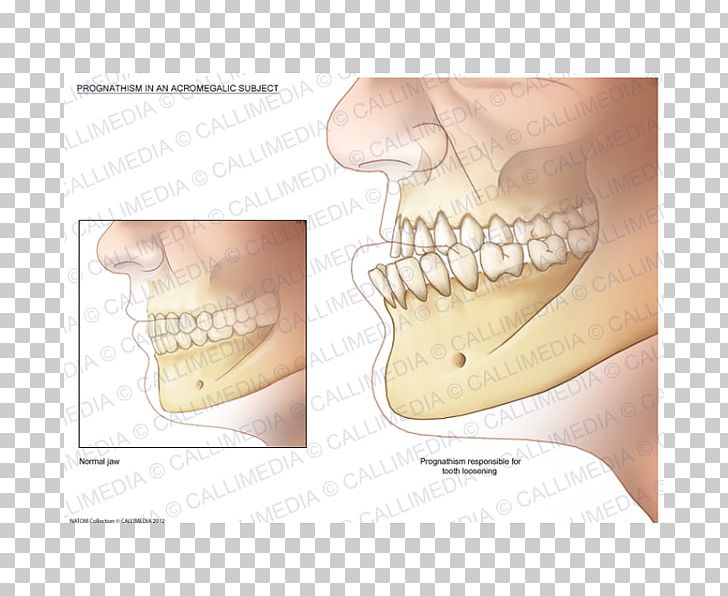 Acromegaly Prognathism Jaw Endocrinology Symptom PNG, Clipart, Acromegaly, Bone, Endocrinology, Finger, Growth Hormone Free PNG Download