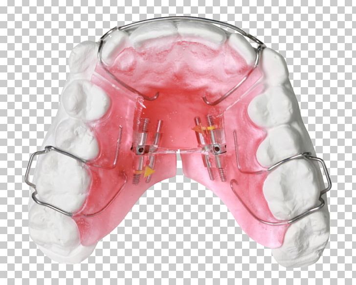 Orthodontics Dental Braces Dentist Retainer Tooth PNG, Clipart, Appliances, Bostan, Clear Aligners, Dental Braces, Dentist Free PNG Download