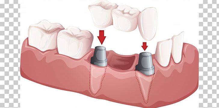 Bridge Dentistry Crown Dental Implant PNG, Clipart, Bridge, Cosmetic Dentistry, Crown, Dental, Dental Implant Free PNG Download
