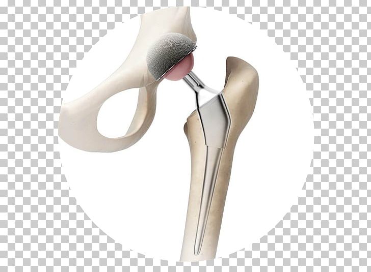 Hip Replacement Prosthesis Knee Replacement PNG, Clipart, Arthroscopy, Bone, Hip, Hip Replacement, Implant Free PNG Download