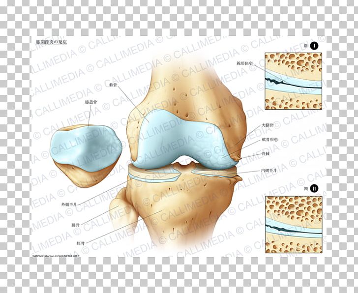 Tibia Knee Pain Bone Fracture Joint PNG, Clipart, Back Pain, Bone, Bone Fracture, Carpal Bones, Disease Free PNG Download
