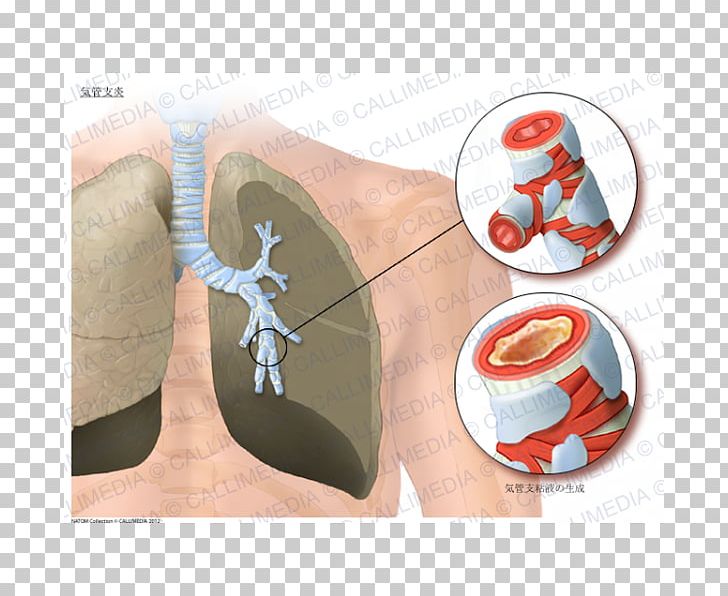 Acute Bronchitis Asthma Lung Bronchiolitis Bronchus PNG, Clipart, Acromegaly, Acute Bronchitis, Anatomy, Apnea, Arm Free PNG Download