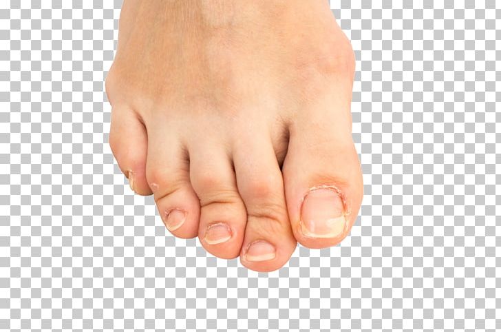 Hammer Toe Bard Podiatry Associates: Mina Baskhron PNG, Clipart, Ache, Bunion, Finger, Foot, Fungus Free PNG Download