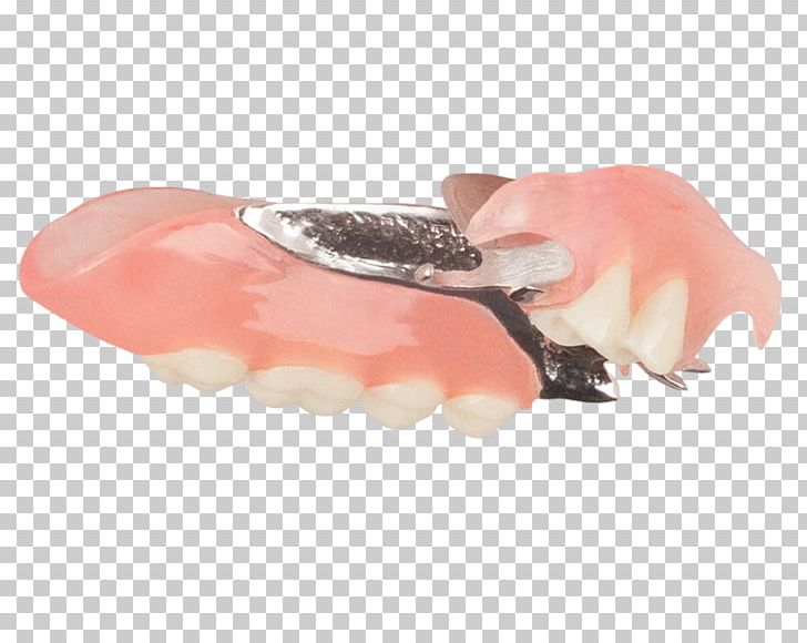 Removable Partial Denture Dentures Mouth Dentistry Tooth PNG, Clipart, Aspen Dental, Dentistry, Dentures, Digital Media, Finger Free PNG Download