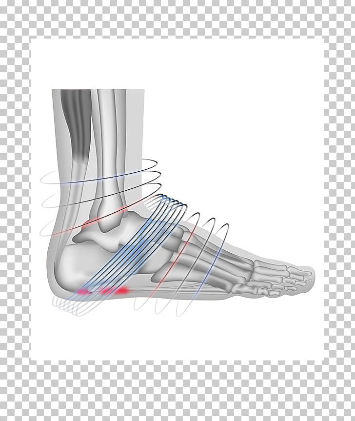Plantar Fasciitis Extracorporeal Shockwave Therapy Plantar Fascia Foot PNG, Clipart, Achilles Tendinitis, Achilles Tendon, Ankle, Arm, Calcaneal Spur Free PNG Download