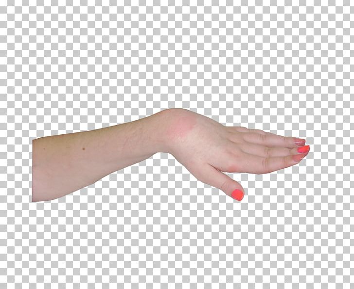 Thumb Hand Model Nail PNG, Clipart, Arm, Edema, Finger, Hand, Hand Model Free PNG Download