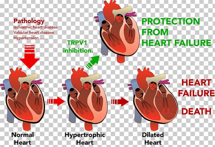 Heart Failure Ventricular Hypertrophy Cardiovascular Disease PNG, Clipart, Cardiac Arrest, Cardiology, Cardiomyopathy, Cardiovascular Disease, Chicken Free PNG Download