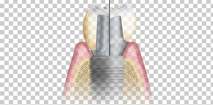 Abutment Dental Implant CAD/CAM Dentistry Implantology PNG, Clipart, Abutment, Bisphosphonate, Cadcam Dentistry, Cosmetic Dentistry, Dental Implant Free PNG Download