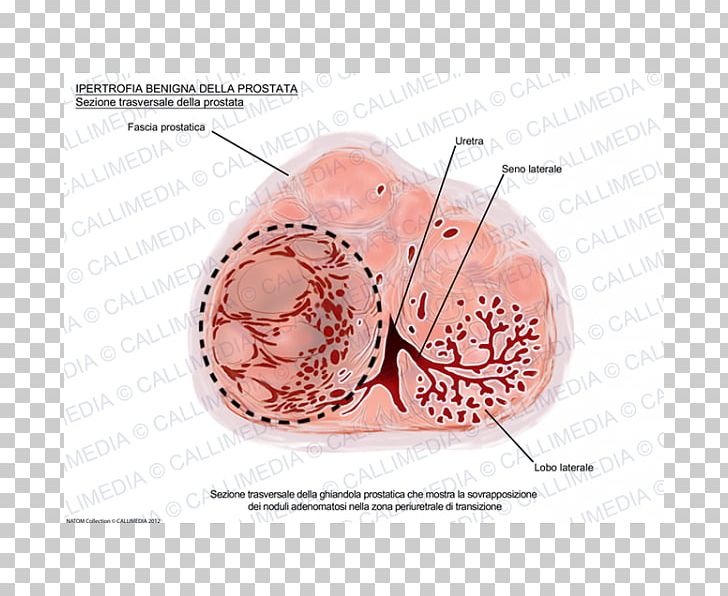 Benign Prostatic Hyperplasia Prostate Cancer Hypertrophy Benignity PNG, Clipart, Benignity, Benign Prostatic Hyperplasia, Benign Tumor, Ejaculation, Erectile Dysfunction Free PNG Download