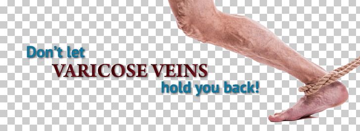 Finger Phlebitis Vein Thrombosis Human Leg PNG, Clipart, Arm, Brand, Crus, Ear, Finger Free PNG Download