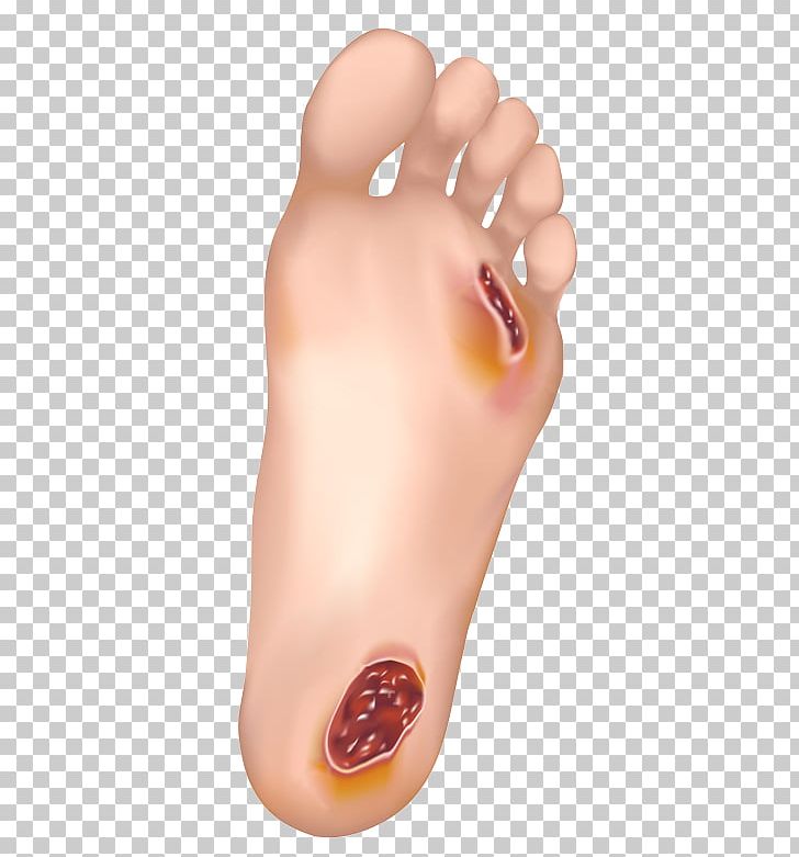 Diabetic Foot Ulcer Diabetes Mellitus Disease Podiatrist PNG, Clipart, Cardiovascular Disease, Diabetic Foot, Diabetic Neuropathy, Finger, Foot Free PNG Download