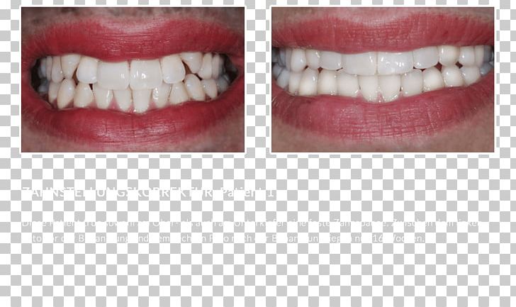 Tooth PNG, Clipart, Chin, Cosmetic Dentistry, Jaw, Lip, Mouth Free PNG Download