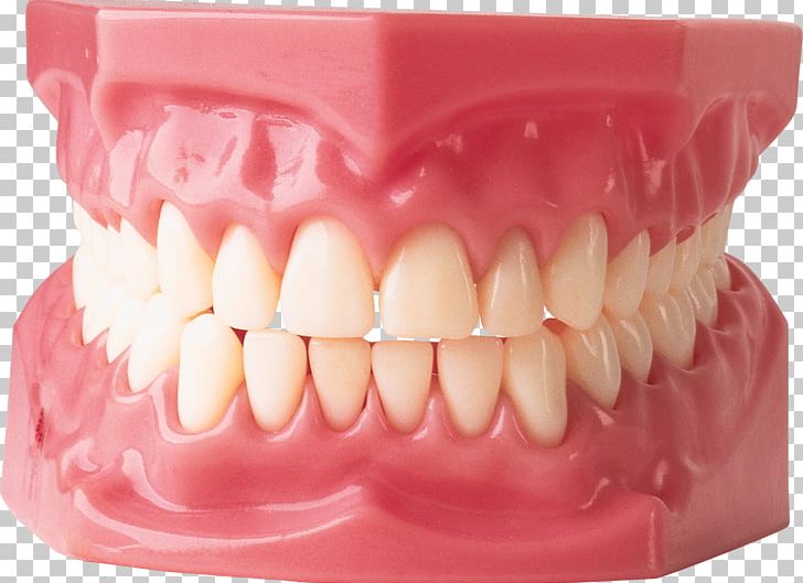 Cosmetic Dentistry Gums Human Tooth PNG, Clipart, Dental Implant, Dental Public Health, Dentist, Dentistry, Dentures Free PNG Download