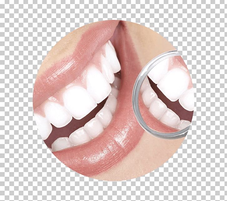 Cosmetic Dentistry Tooth Periodontology PNG, Clipart, Allon4, Clear Aligners, Cosmetic Dentistry, Crown, Dentist Free PNG Download
