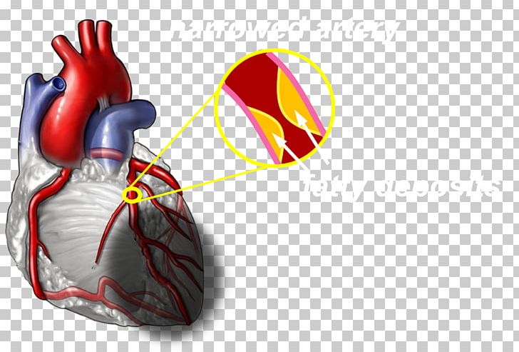 Coronary Artery Disease Heart Cardiovascular Disease Myocardial Infarction Health PNG, Clipart, Artery, Arthritis, Cardi, Cardiology, Coronary Arteries Free PNG Download