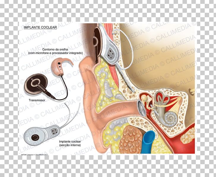 Cochlear Implant Hearing PNG, Clipart, Cochlea, Cochlear Implant, Cochlear Limited, Cochlear Nerve, Dental Implant Free PNG Download