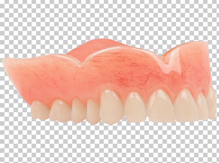 Dentures Tooth Dentistry Aspen Dental Acrylic Resin PNG, Clipart, Acrylic Resin, Appointment, Aspen, Aspen Dental, Classic Free PNG Download