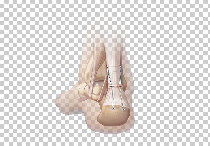 Achilles Tendinitis Surgery Surgical Suture Achilles Tendon PNG, Clipart, Achilles, Achilles Heel, Achilles Tendinitis, Achilles Tendon Rupture, Ankle Free PNG Download
