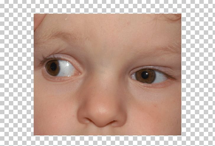 Duane Syndrome Eye Movement Differential Diagnosis PNG, Clipart, Child, Chin, Closeup, Corneal Limbus, Differential Diagnosis Free PNG Download