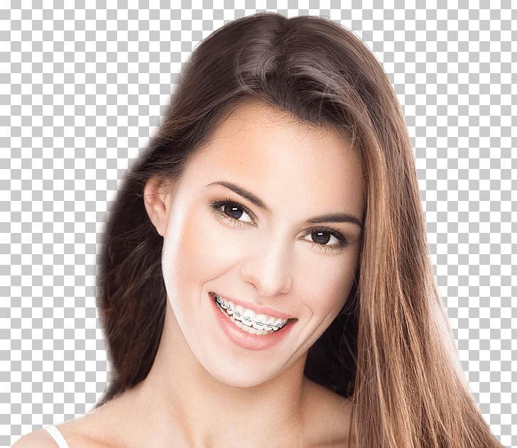 Dental Braces Clear Aligners Cosmetic Dentistry Orthodontics PNG, Clipart, Beauty, Brown Hair, Cheek, Chin, Clear Aligners Free PNG Download