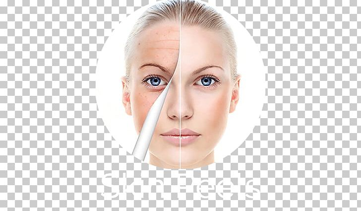 Facial Chemical Peel Wrinkle Face Anti-aging Cream PNG, Clipart, Antiaging Cream, Beauty, Botulinum Toxin, Cheek, Chemical Peel Free PNG Download