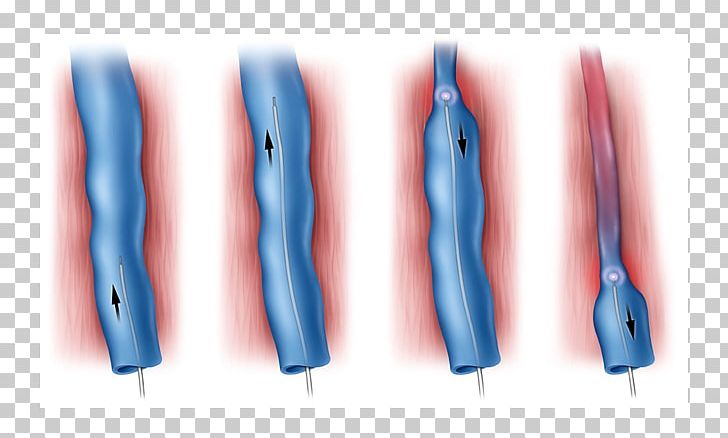 Endovenous Laser Treatment Varicose Veins Surgery PNG, Clipart, Arm, Blood, Blue, Compression Stockings, Electric Blue Free PNG Download