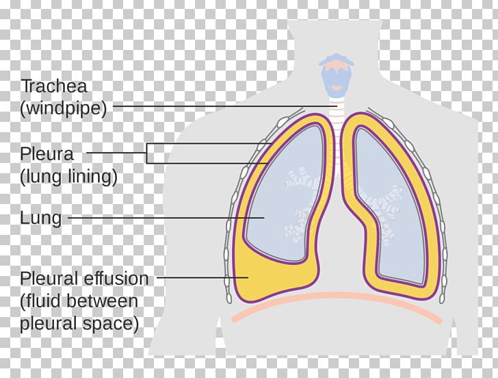 ICD-10 Pleural Effusion Pleural Cavity Lung PNG, Clipart, Angle, Area, Brand, Breathing, Cavity Free PNG Download