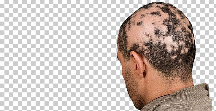 Alopecia Areata Non Scarring Hair Loss Pattern Hair Loss PNG, Clipart, Alopecia Areata, Autoimmune Disease, Chin, Dermatology, Disease Free PNG Download