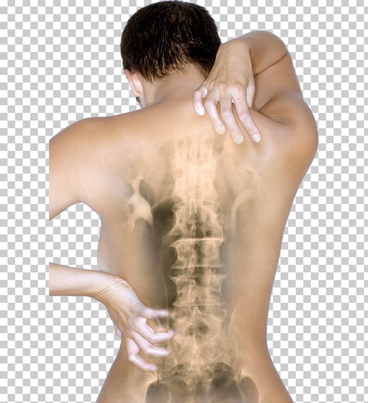 Osteochondrosis Vertebral Column Disease Mugurkaula Osteohondroze Pain PNG, Clipart, Abdomen, Arm, Back, Barechestedness, Cartilage Free PNG Download