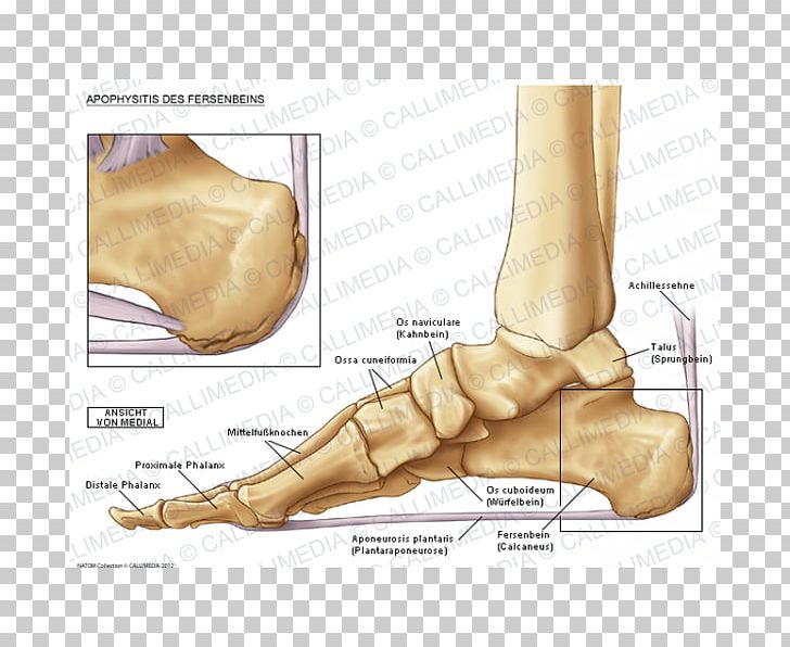 Foot Sever's Disease Osteochondrosis Podiatry PNG, Clipart,  Free PNG Download