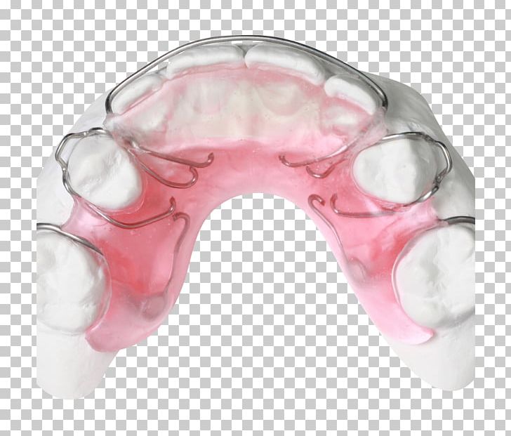 Gergen's Orthodontic Lab Gergens Orthodontic Lab Orthodontic Technology Orthodontics Bionator PNG, Clipart, Bionator, Gergens Orthodontic Lab, Gergens Orthodontic Lab, Home Appliance, Jaw Free PNG Download
