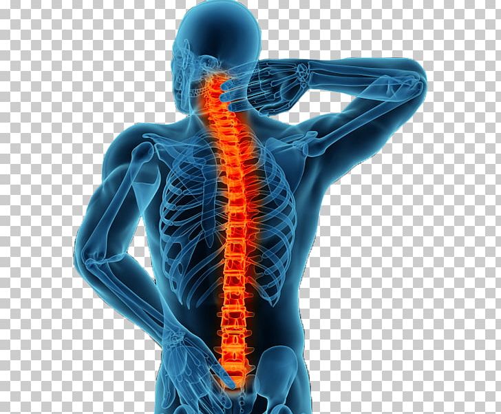 Vertebral Column Minimally Invasive Spine Surgery Spinal Fusion Back Pain PNG, Clipart, Back Pain, Cage, Cervical, Chiropractor, Electric Blue Free PNG Download