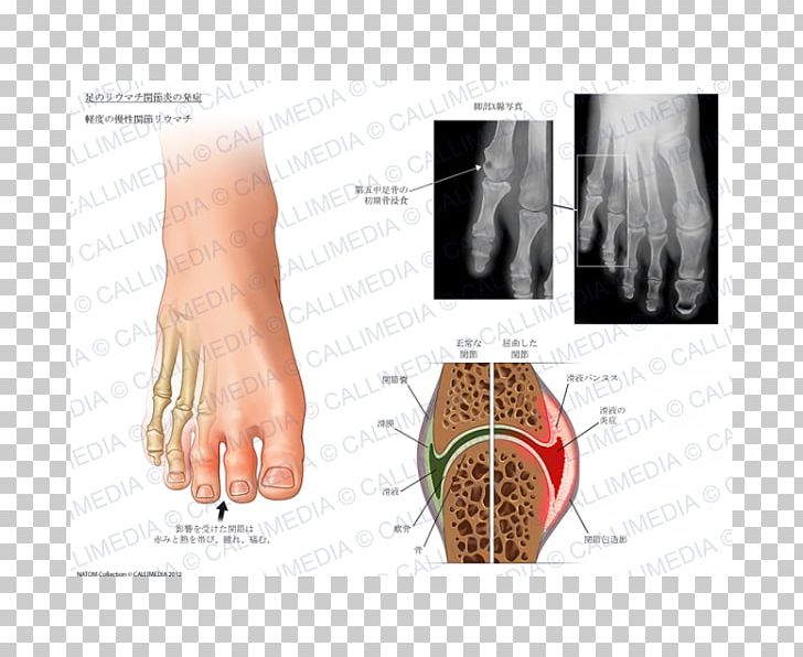 Nail Arthritic Pain Rheumatoid Arthritis Foot Joint PNG, Clipart, Abdomen, Anatomy, Ankle, Arm, Autoimmune Disease Free PNG Download