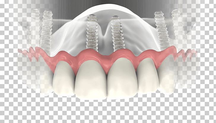 Dental Implant Dentistry Dentures PNG, Clipart,  Free PNG Download